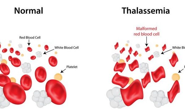 Kurkumin untuk Pengidap Thalassemia
