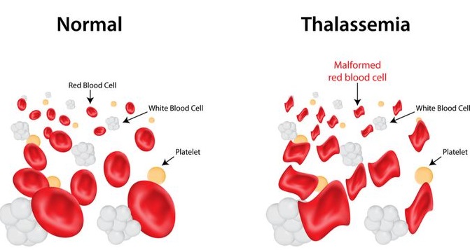 Kurkumin untuk Pengidap Thalassemia